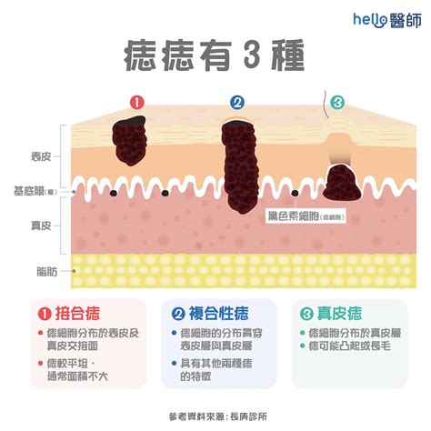 痣突出來|痣變大凸起：皮膚科醫生解答摳痣風險與後果